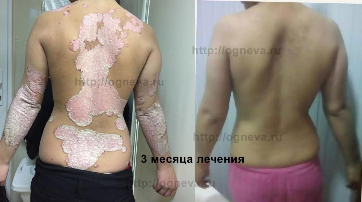 Лечение детского псориаза отзывы