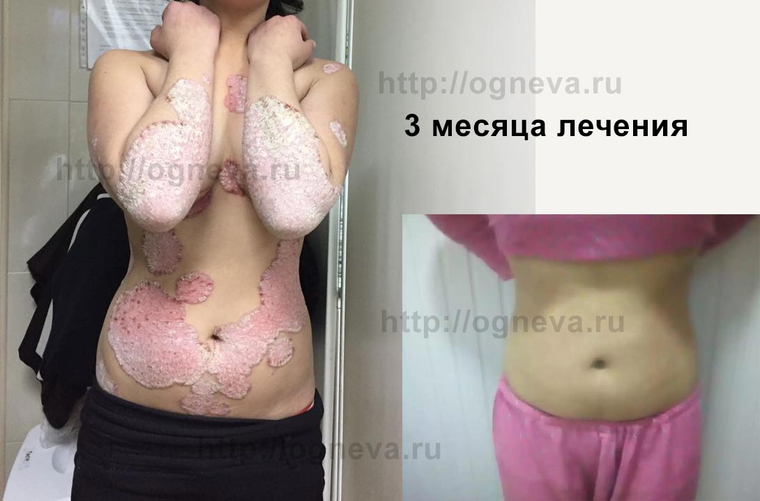 Лечение детского псориаза до и после